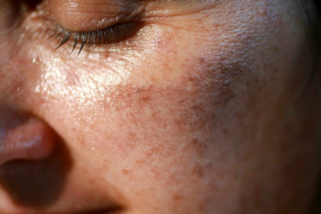 Hyperpigmentation