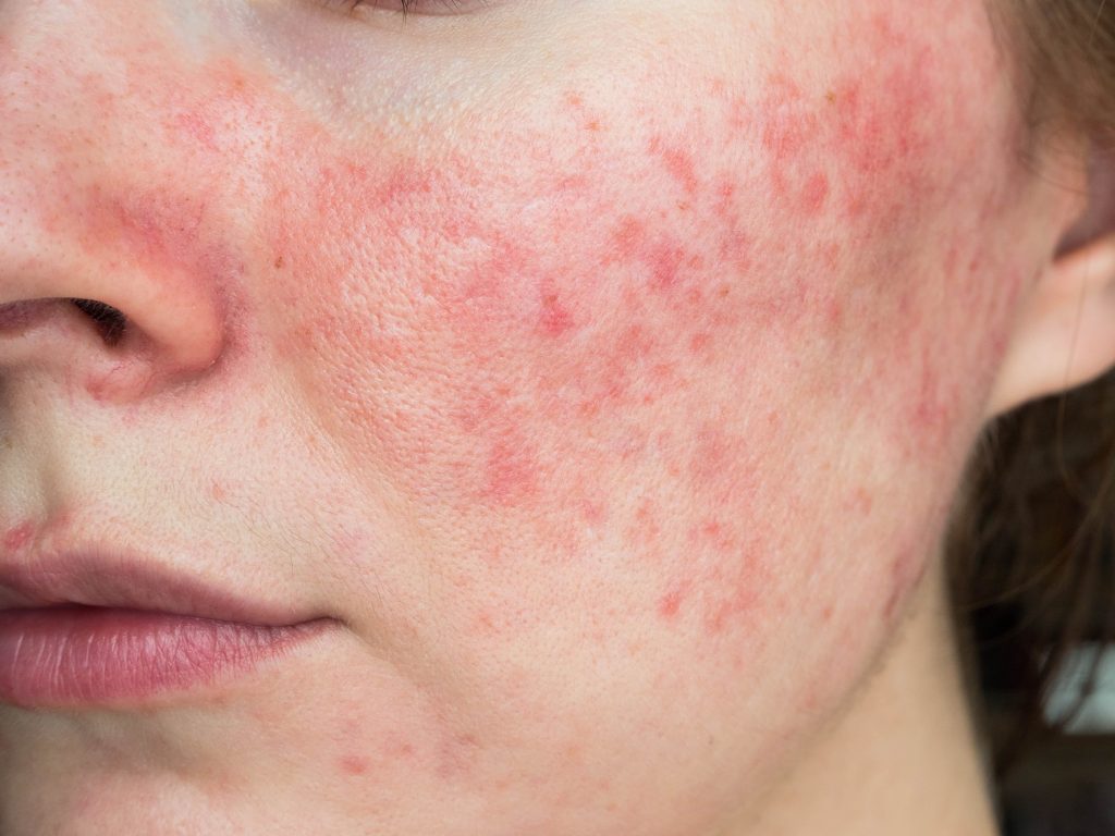 Skin Prone to Redness