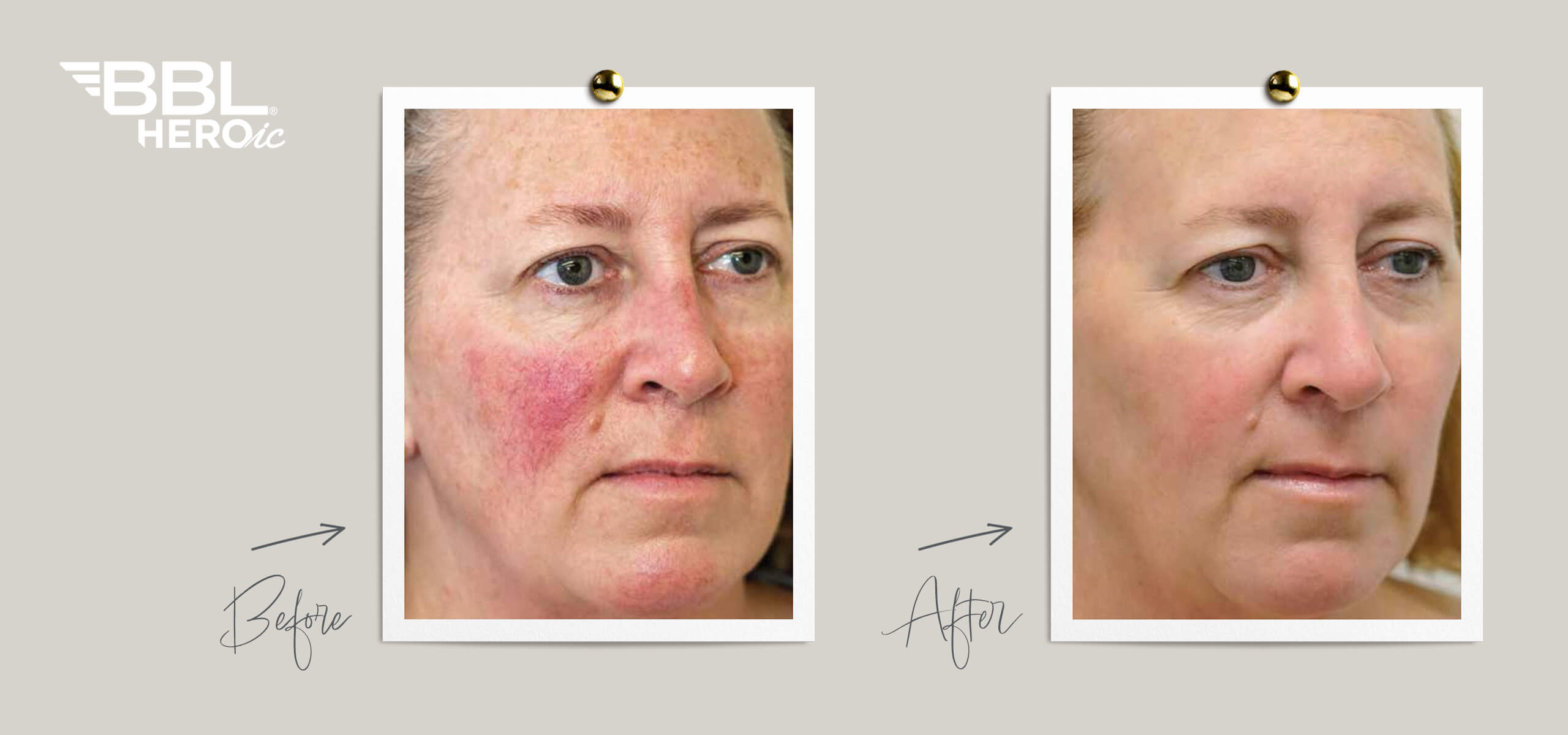 Before and After photos of BBL Heroic Laser