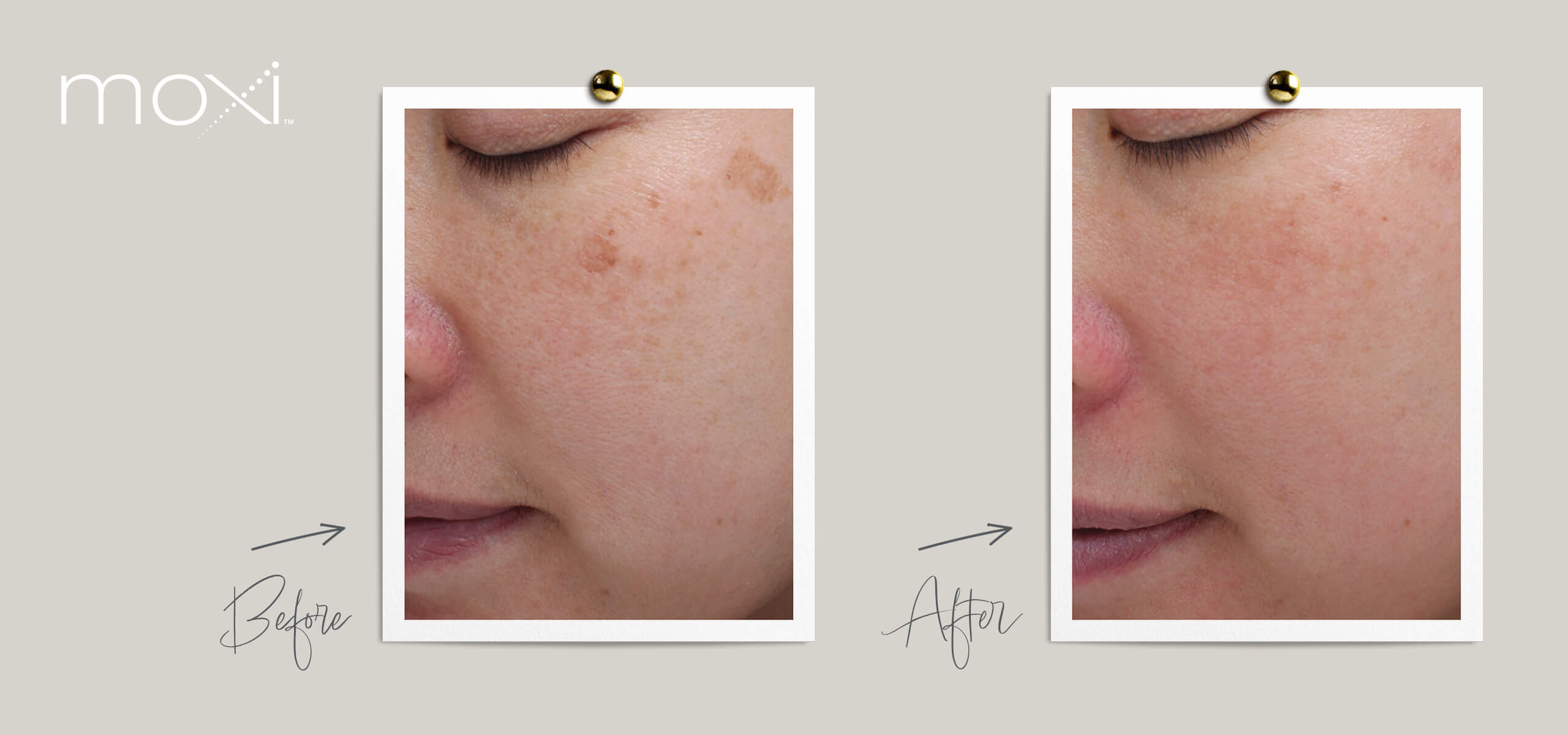 Before and After photos of Moxi Laser