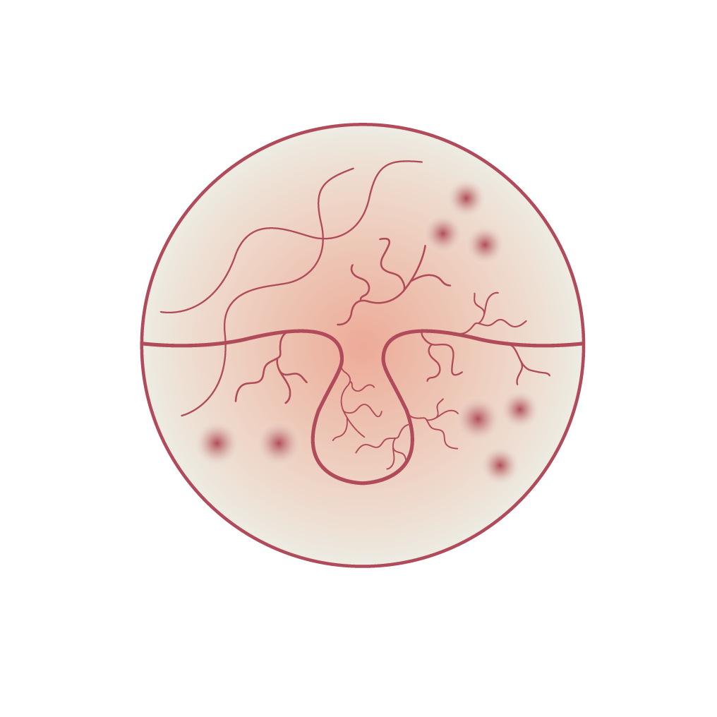 Rosacea and Redness