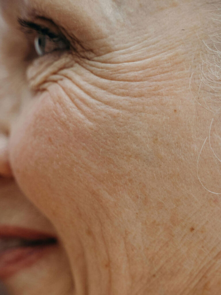 Skin Laxity and skin ageing